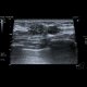 Calcifications in breast: US - Ultrasound